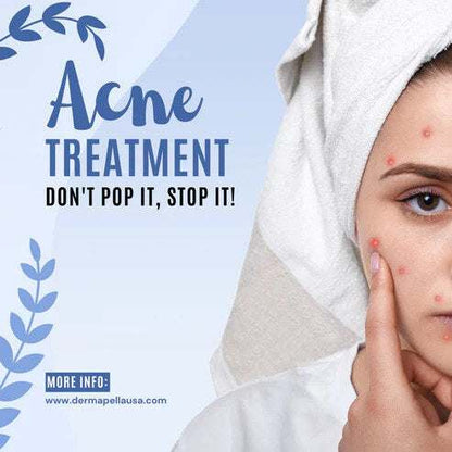 cream for pimples,pimple cream,gel acne,acne gel treatment